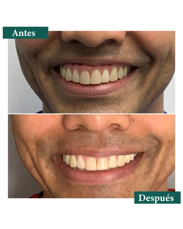 ✨ ¿Sabías que tu sonrisa puede lucir aún más perfecta sin cirugía? 😁En esta transformación, mostramos el ANTES y DESPUÉS de un tratamiento con toxina botulínica que reduce la visibilidad de la encía al sonreír, dándole un toque natural y equilibrado a tu sonrisa.👩‍⚕️ Este tratamiento no invasivo es rápido, seguro y te ayuda a mostrar una sonrisa más armónica, eliminando la incomodidad de ver demasiada encía.👉Recupera la confianza en tu sonrisa y ¡deja que tu belleza natural brille! 🌟🔍 ¿Te gustaría saber más sobre este tratamiento? Mándanos un DM o comenta abajo, ¡estamos para ayudarte! 💬#SonrisaPerfecta #EstéticaDental #sonrisagingival #toxinabotulinica #tratamientonoinvasivo #ConfianzaEnTuSonrisa #cuidadodental #botox #mede #colombia #estéticadental