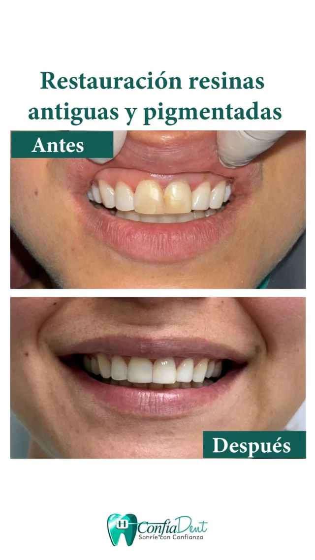 Hace años, un accidente dejó huella en la sonrisa de este joven, fracturando sus dientes incisivos superiores. Afortunadamente, con la ayuda de resinas estéticas avanzadas, hemos logrado transformar completamente su sonrisa. 💫

Gracias a las últimas técnicas en restauración dental, conseguimos una sonrisa natural, armónica y funcional que se adapta perfectamente a su rostro. Cada detalle fue cuidadosamente diseñado para que se vea y sienta como propia. 😁

Porque tu sonrisa es única, mereces lo mejor en cada tratamiento. Si sientes que tu sonrisa necesita un cambio, ¡estamos aquí para ayudarte a lograrlo! 💬

#RestauraciónDental #SonrisaNatural #EstéticaDental #ResinasEstéticas #TransformaciónSonrisa #sonrisarenovada #SaludDental #ConfianzaEnTuSonrisa #esteticadental #colombia #medellin #dentista #mede #